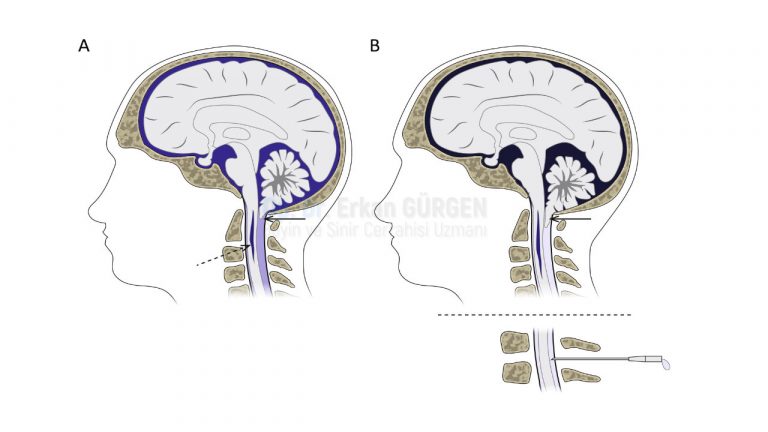 Chiari Malformasyonu